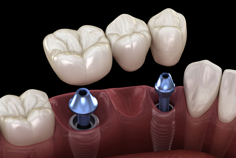 dental bridge