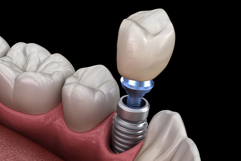 single dental implant