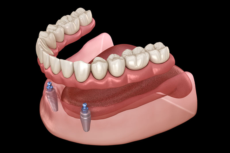 snap in denture