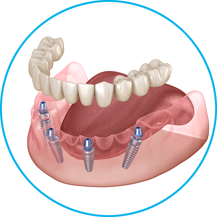 ALL on 4 implants